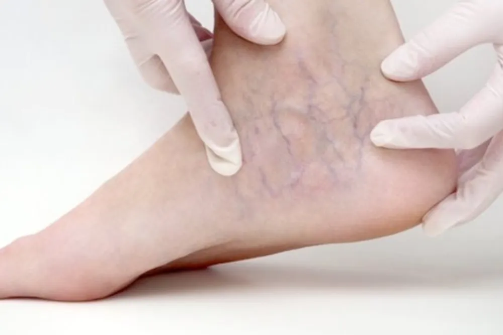 Ödemden kurtulmanın 7 yolu