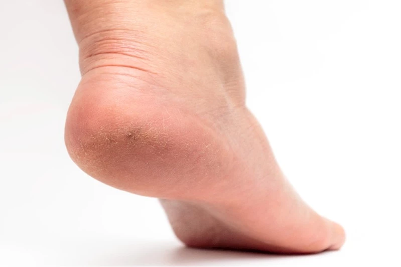 Diyabetlilerde topuk çatlağı kangrene kadar gidebiliyor!
