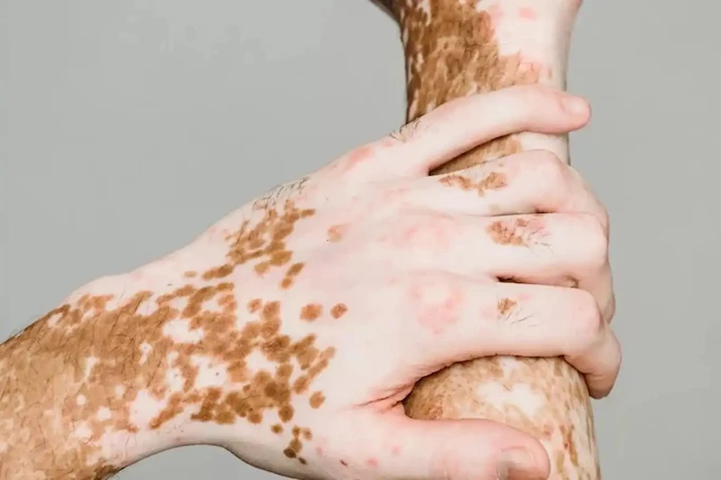 25 Haziran dünya vitiligo günü dolayısıyla farkındalık çağrısı