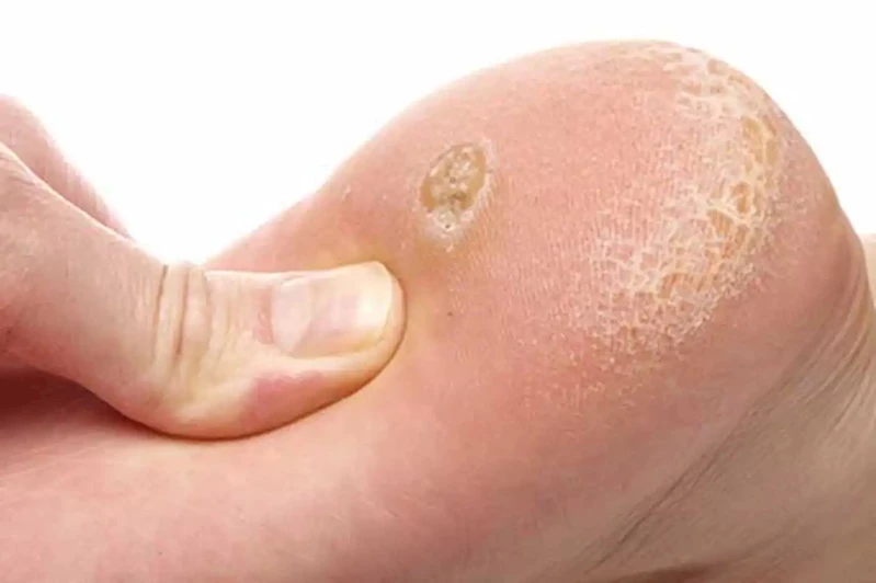 Uzman uyardı: Mantar enfeksiyonları yazın ayak araları ve kasıkta artıyor