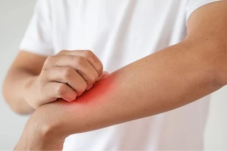 Cildinizde renk değişiklikleri varsa yaz mantarı olabilir